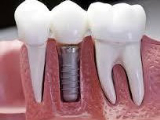 Implant dentar 2