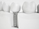 Implant Dentar